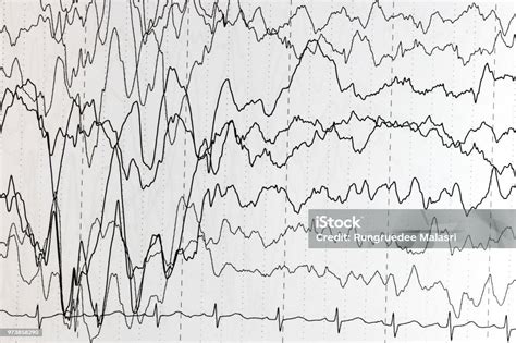 Eeg Lectroenc Phalogramme D Finition Comment Se D Roule L Examen