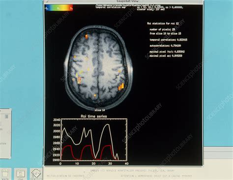 Eeg Of Brain Activity During Mathematical Thought Stock Image P335