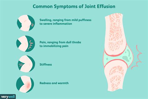 Effusion In A Joint