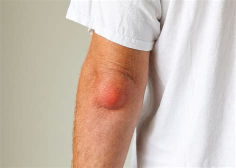 Elbow Bursitis Therapy