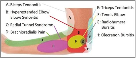 Elbow Pain Diagram Diagnosis Chart