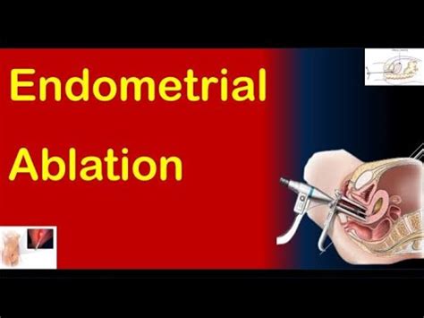 Endometrial Ablation Recovery What To Expect