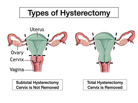 Endometriosis And Hysterectomy