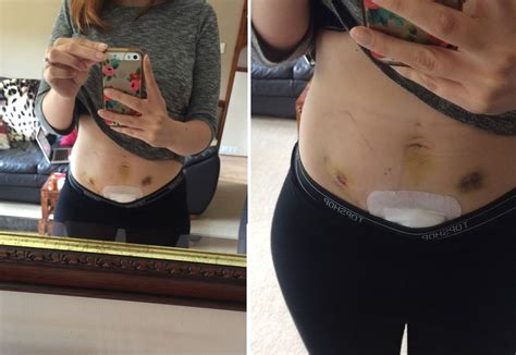 Endometriosis Laparoscopy Scar Operation Zoey Olivia Blogger Stage 4