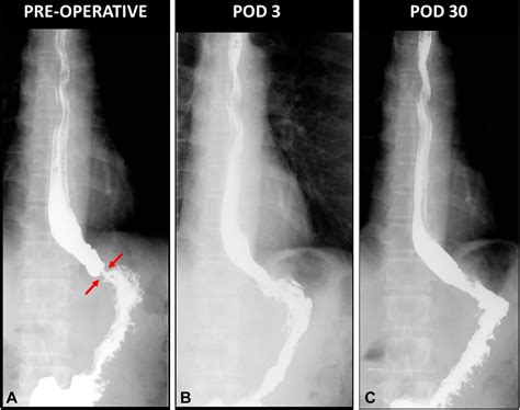 Endoscopic Mucoplasty For Benign Esophageal Strictures Multiple