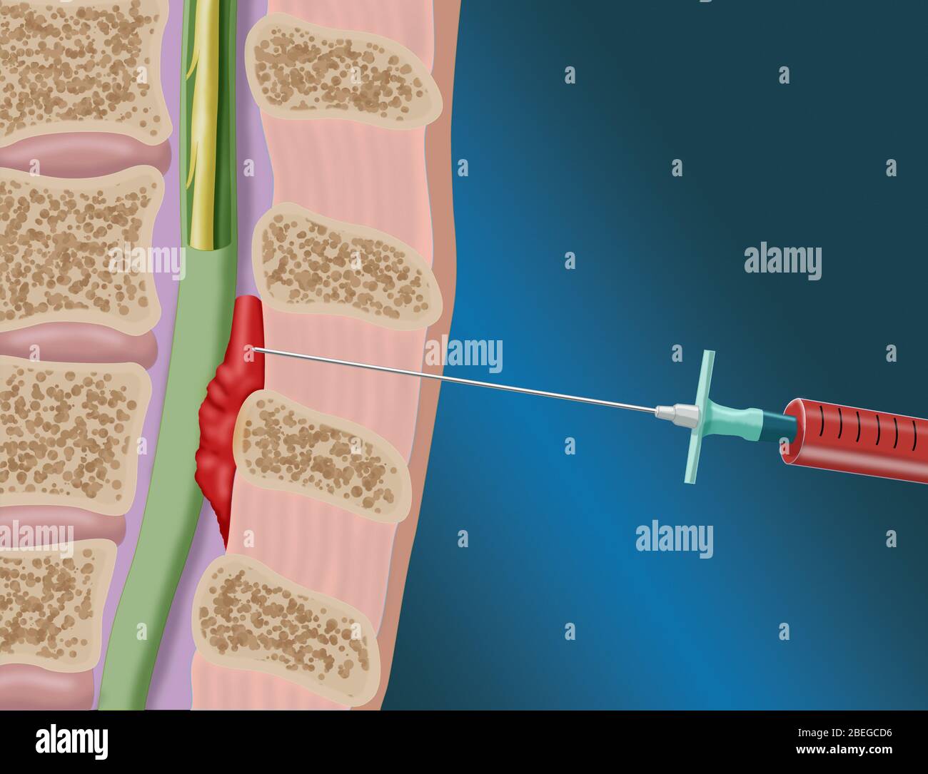 Epidural Blood Patch Procedure