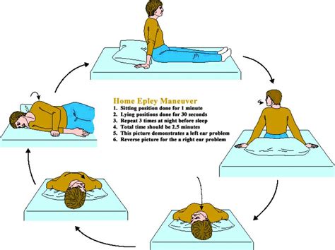 Epley Maneuver Vertigo Exercises