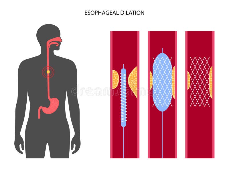 Esophageal Balloon Dilation