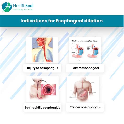 Esophageal Dilation Procedure