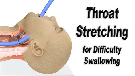 Esophagus Stretching Procedure