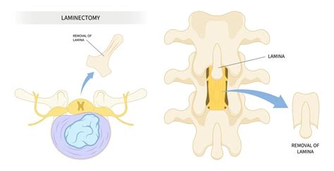 Exercises To Avoid After A Lumbar Laminectomy Freaktofit