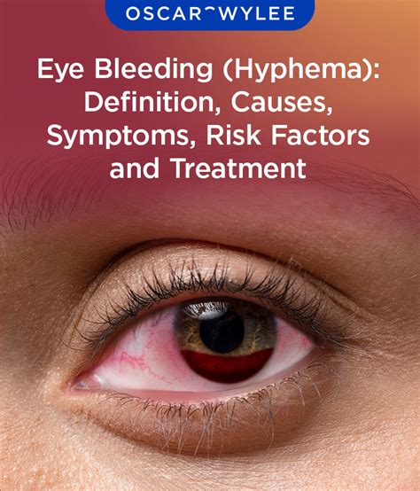 Eye Bleeding Hyphema Definition Causes Symptoms Risk Factor And