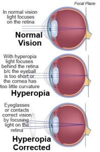 Farsightedness Hyperopia Christopherson Eye Clinic