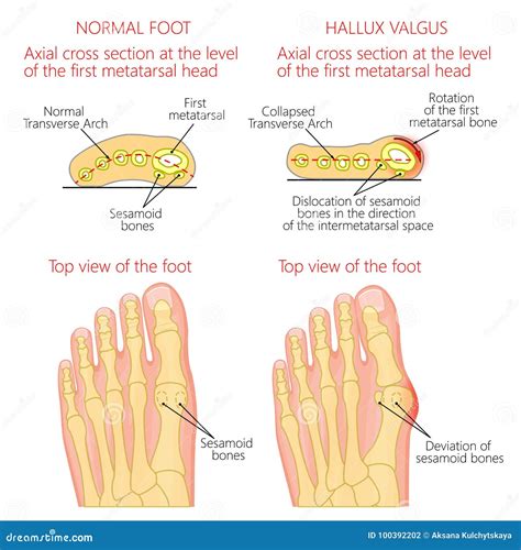 Feet Anatomy: Solve Foot Pain