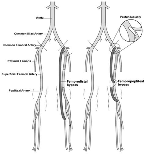 Fem Pop Bypass