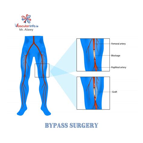 Femoral Femoral Artery Bypass Bypass Surgery Best Hospitals Surgery