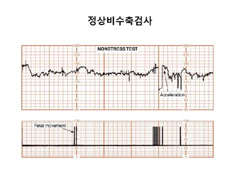 Fetal Movements Fetal Breathing Contraction Stress Testing Nonstress