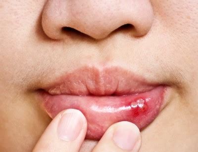 Fever Blisters And Home Remedies For Relief Harris Dental