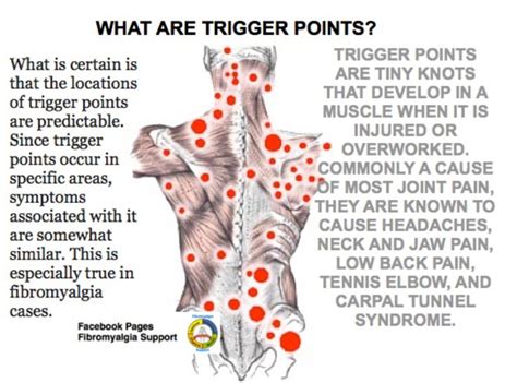 Fibro Trigger Points Diagram Best Free Home Design Idea Amp Inspiration