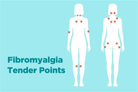 Fibromyalgia Pressure Points