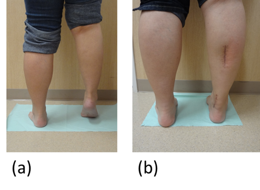 Figure 1 From Concomitant Achilles Tendon Lengthening With