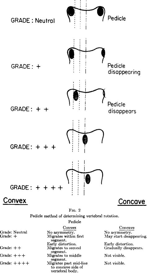 Figure 2 From A Study Of Vertebral Rotation Semantic Scholar