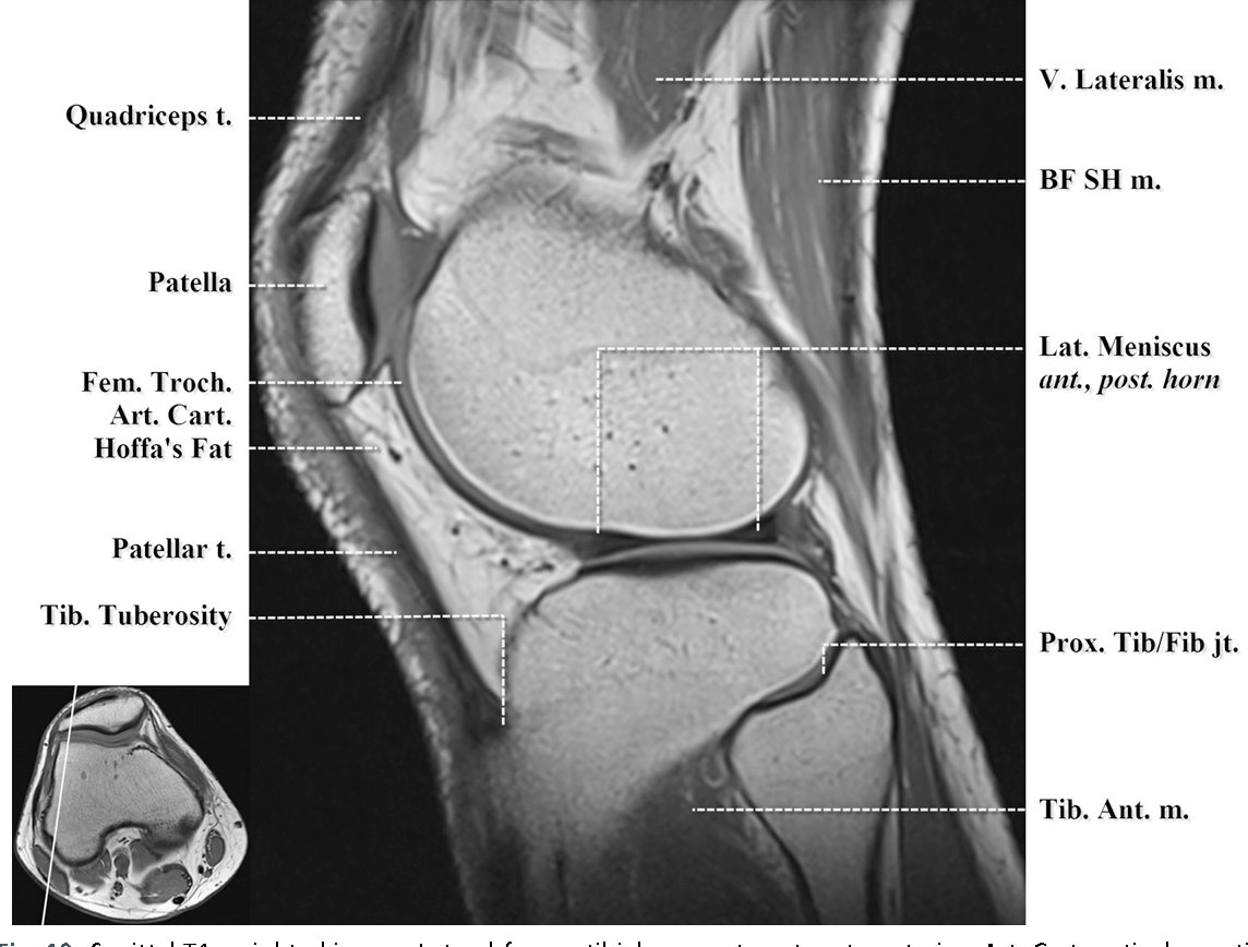 Figure 8 From Normal Mr Imaging Anatomy Of The Knee Semantic Scholar