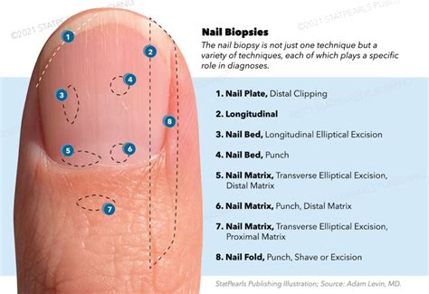 Figure Nail Biopsy Nail Plate Longitudinal Statpearls Ncbi