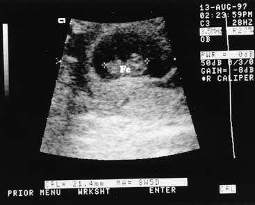 First Trimester Dating Ultrasound Accuracy Telegraph