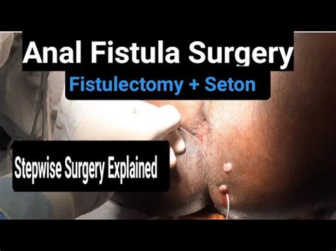 Fistula Ano Surgery: Quick Recovery Tips