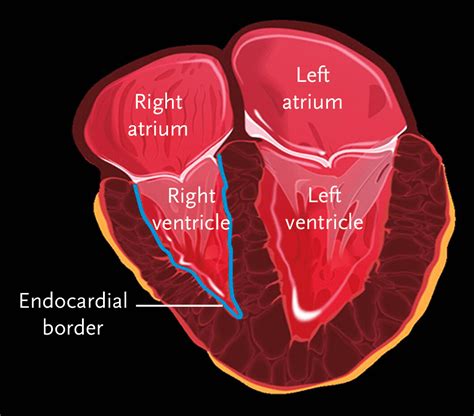 Focused Cardiac Ultrasonography For Right Ventricular Size And Systolic