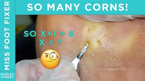 Foot Corn Removal