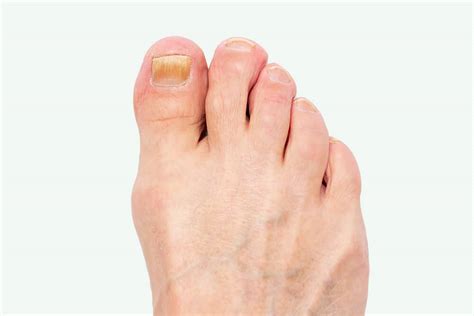 Foot Fungus On Nails Discount Emergencydentistry Com