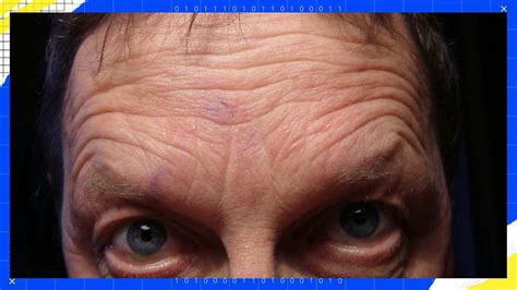 Forehead Wrinkles Causes Deep In Men Fast Remedies Treatments