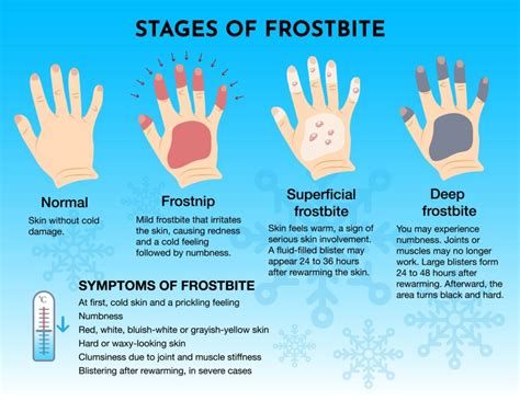 Fourth Degree Frostbite: Prevention Strategies