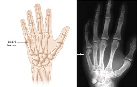 Fracture Finger Heal Time