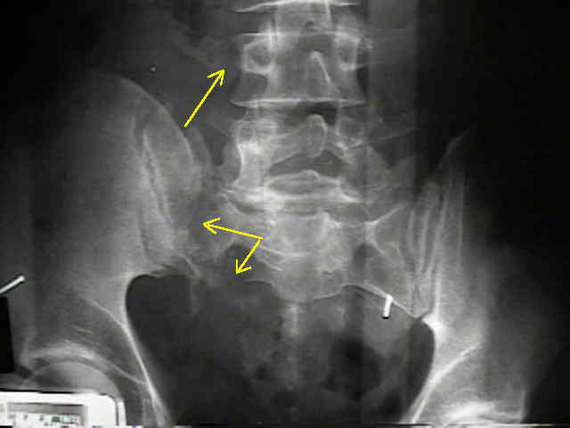 Fractures Of The Sacrum