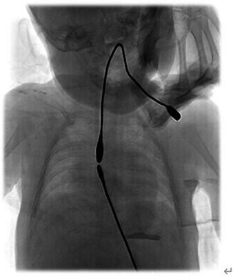 Frontiers Experience In The Treatment Of Long Gap Esophageal Atresia