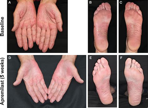 Frontiers Successful Treatment Of Refractory Palmoplantar Pustular