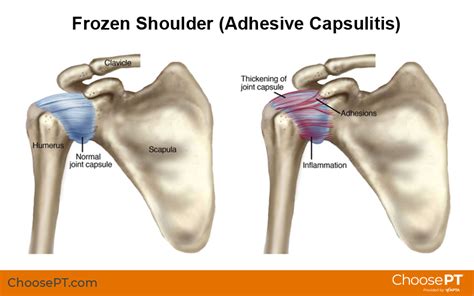 Frozen Shoulder Also Called Adhesive Capsulitis Is A Challenging Painful Condition In Which An Individual Has A Loss Of Range Of Motion In Their Shoulder Including A Loss Of Strength And