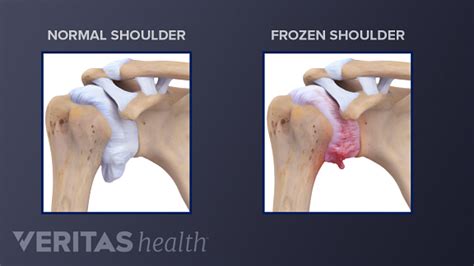 Frozen Shoulder Who Gets Adhesive Capsulitis And What To Do About It Balance Orlando February 2025