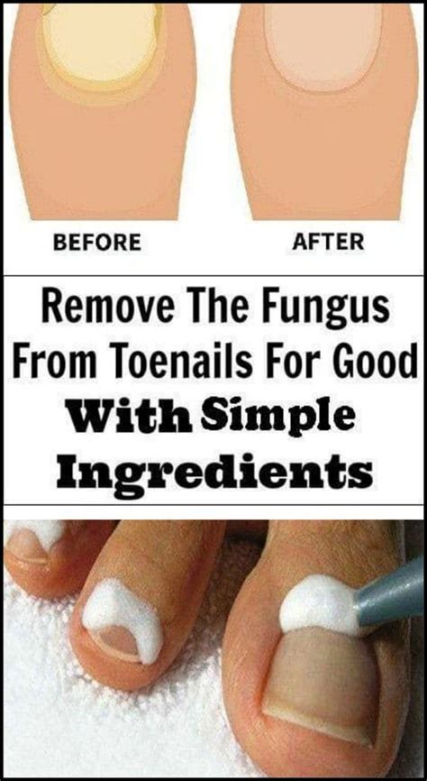 Fungal Nail Removal Guide: Easy Cure