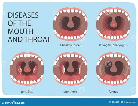 Gallery For Normal Throat Pictures