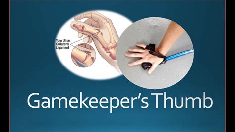 Game Keepers Thumb Guide: Injury Prevention