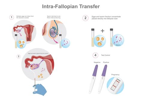 Gamete Intrafallopian Transfer Procedure Success Rate Cost Amp More