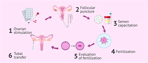 Gamete Intrafallopian Transfer