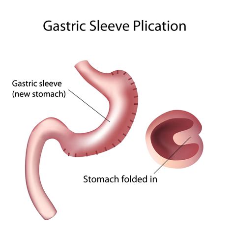 Gastric Sleeve Surgery Vs Gastric Plication Procedure Comparison