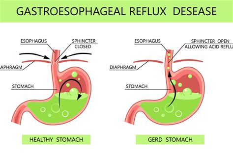 Gastro Esophageal Reflux Or Gerd Treatment In Stomach With Best