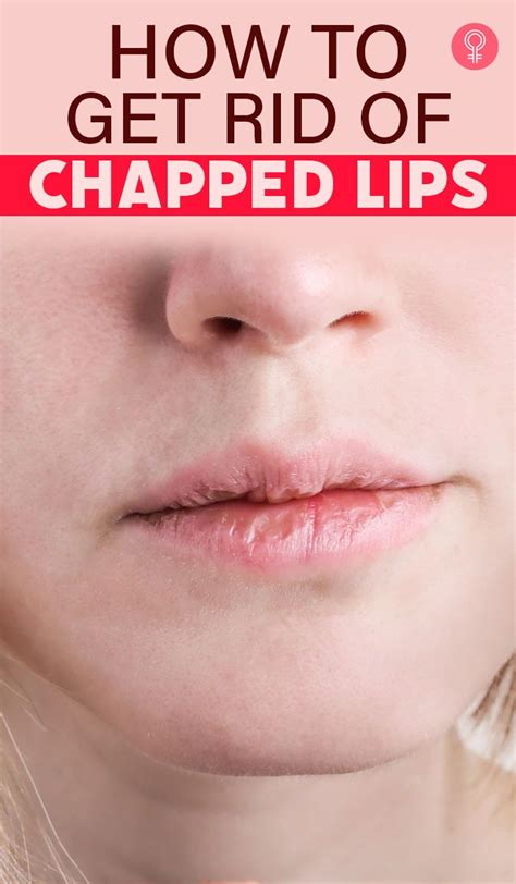 Get Rid Of Chapped Lips Fast Using These 11 Home Remedies