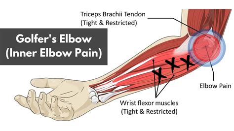 Golfer S Elbow Inner Elbow Pain What Is It And How To Treat It